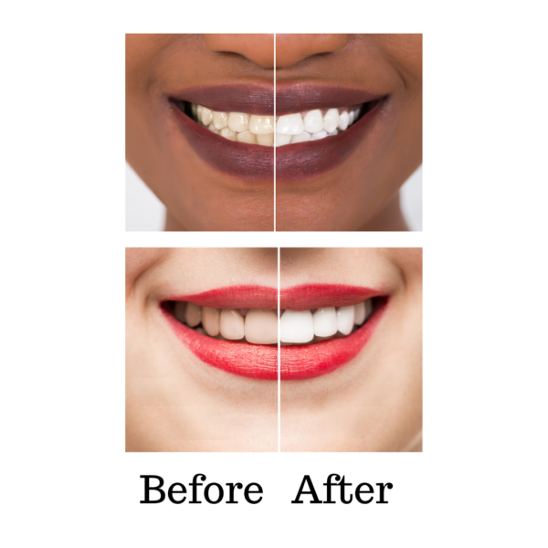 iLED Teeth Whitening Light - Image 7