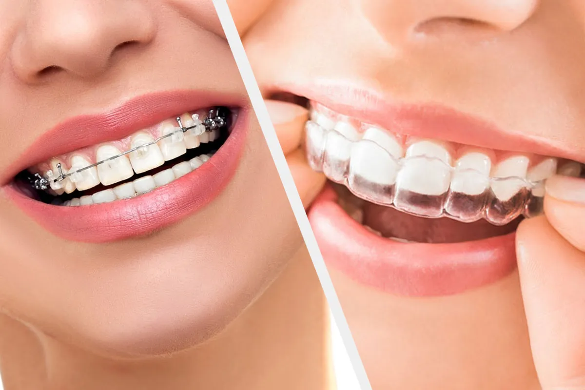 Traditional braces vs Clear aligner braces